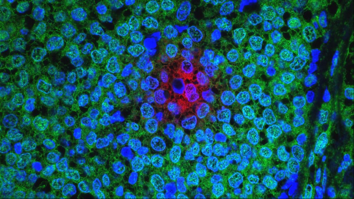 ¿Neutrófilos para mejorar la eficacia de la terapia inmune contra el cáncer de mama?