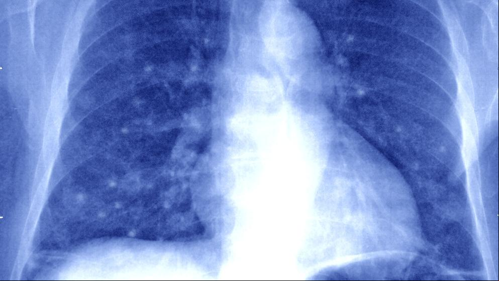 Descubierto un fármaco que inhibe la formación de metástasis